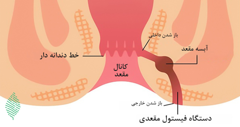 فیستول