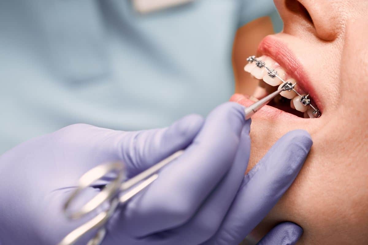Should You Get Braces from a Dentist or an Orthodontist?