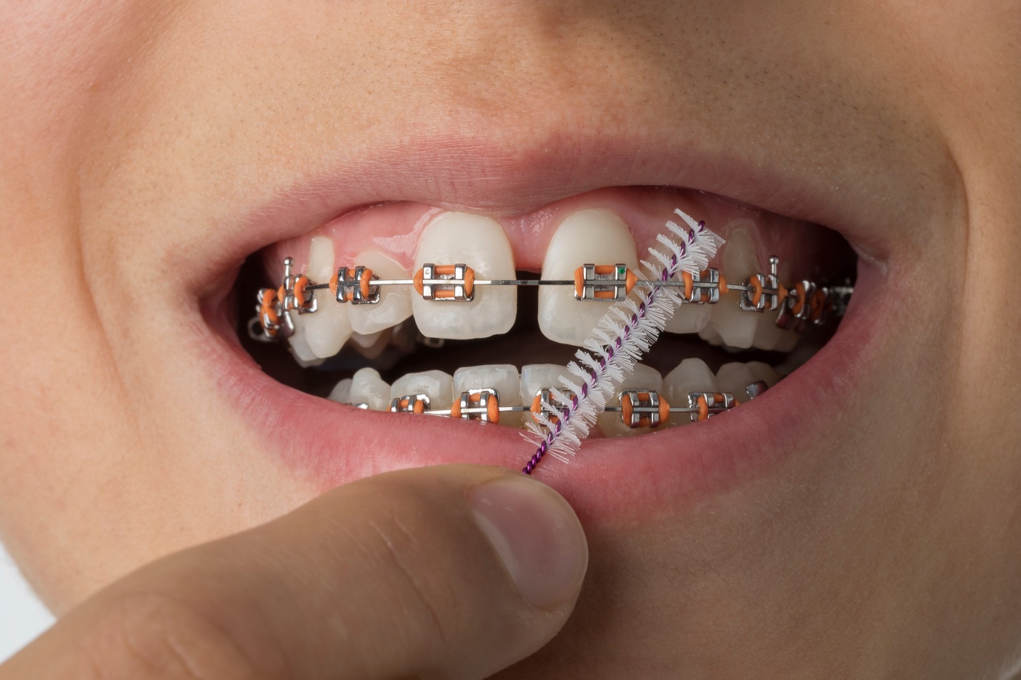 Fixed Appliances | One Smile Dental, Sheffield