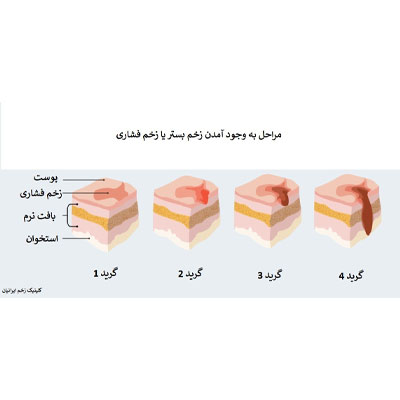 علت ابتلا به زخم بستر و علائم آن