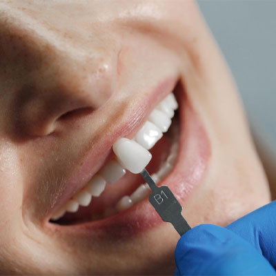 لمینت دندان خرگوشی چیست؟